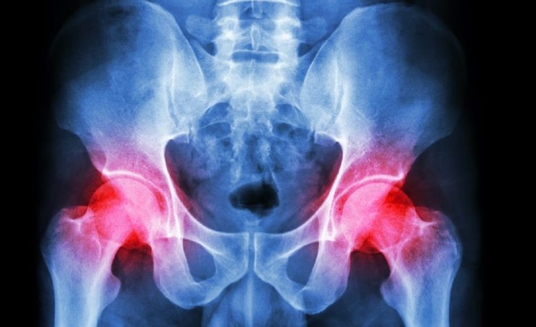 Trabajos incompatibles con prótesis de cadera